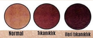 Explanation of skin discoloration and temporary cupping marks after cupping therapy (first image)